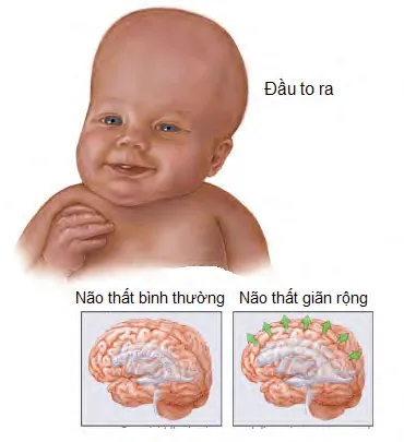 Hội chứng Triple X